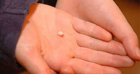 Tooth Growing Out of Foot